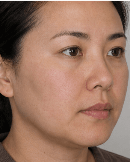 IPL Photofacial: after