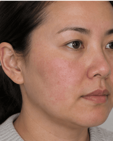 IPL Photofacial: before