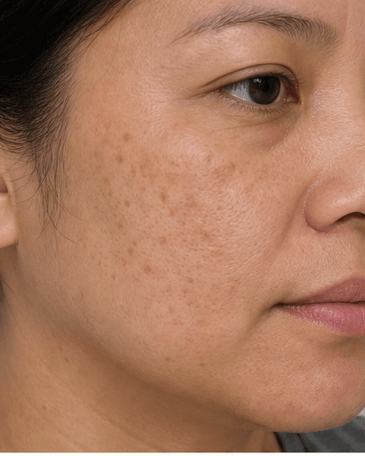 Pico Laser: before
