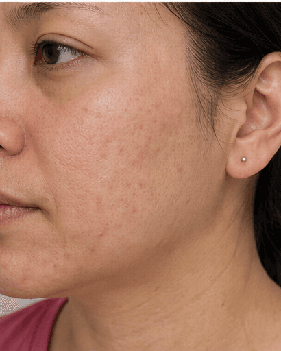 Pico Laser: before