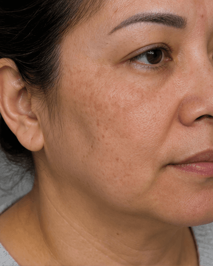 Picosecond Laser: before