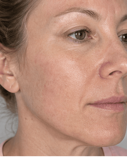 RF Microneedling: after