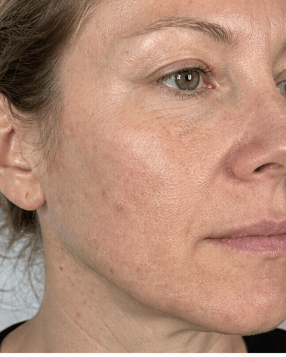 RF Microneedling: before