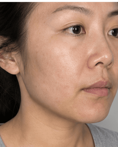 RF Microneedling: after