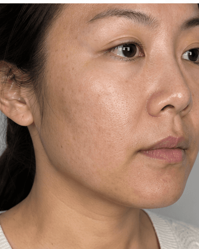 RF Microneedling: before