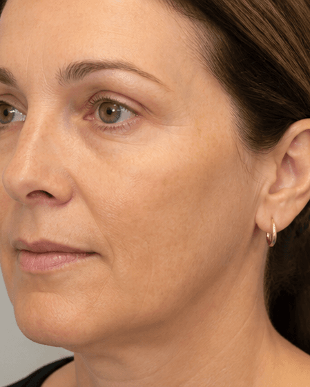Thulium Laser: after