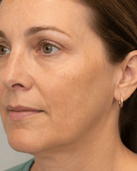 Thulium Laser: before