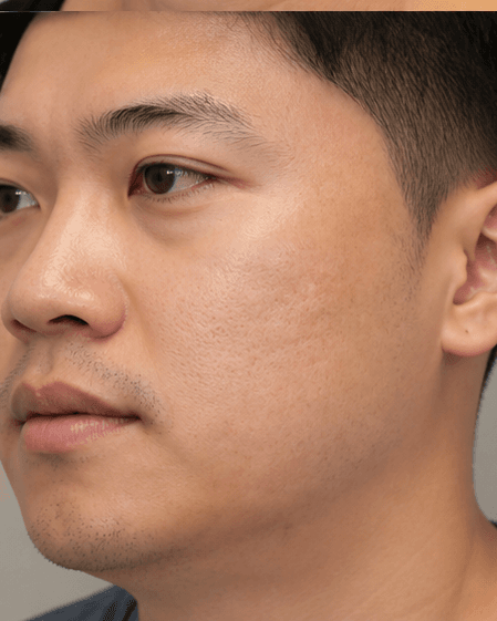 Thulium Laser: after