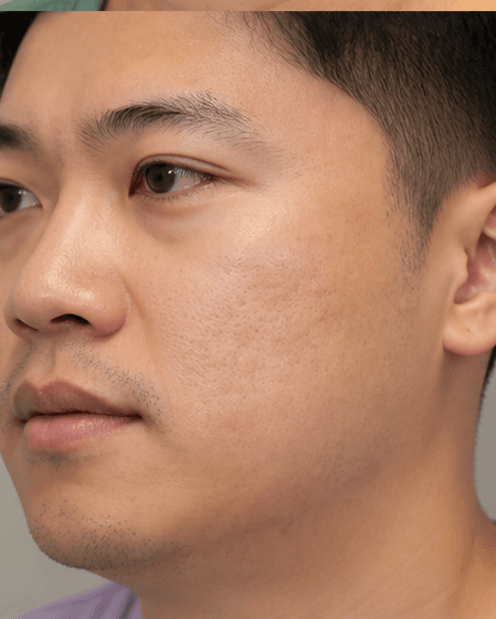 Thulium Laser: before