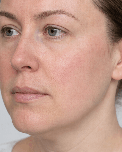 Vascular Laser: after