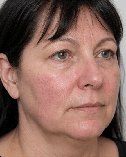 Vascular Laser: before