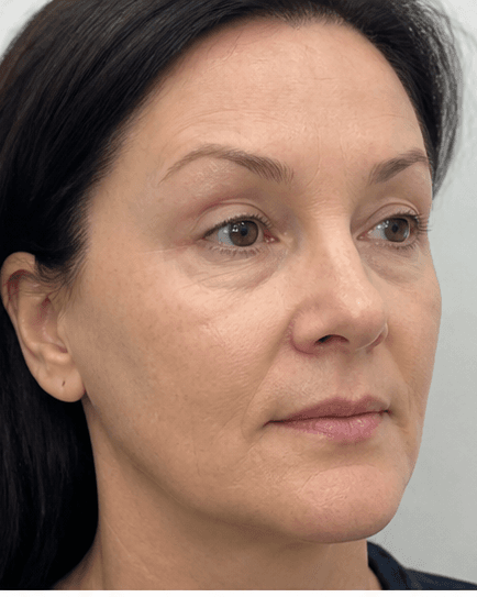 Non-Surgical Brow Lift: after