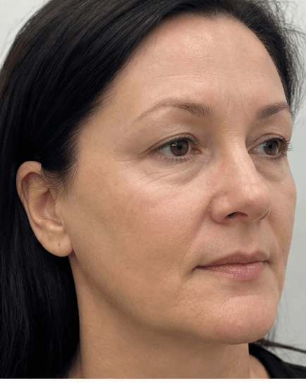 Non-Surgical Brow Lift: before