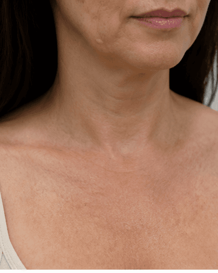 Décolleté Firming: after