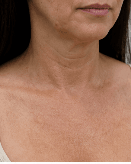 Décolleté Firming: before