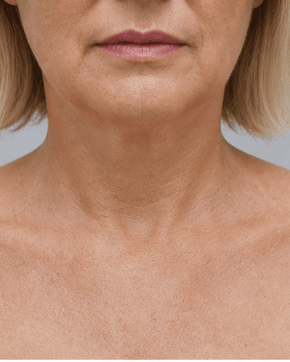 Neck & Décolleté Lift: after