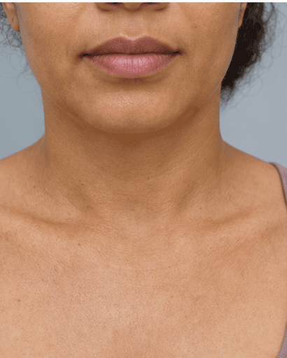 Neck & Décolleté Lift: after