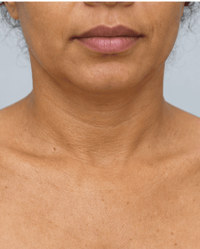 Neck & Décolleté Lift: before