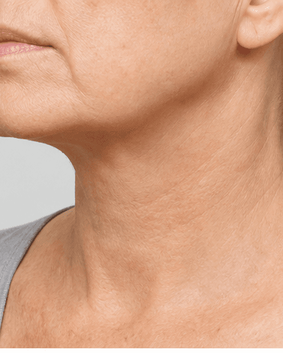 Neck Tightening RF: after