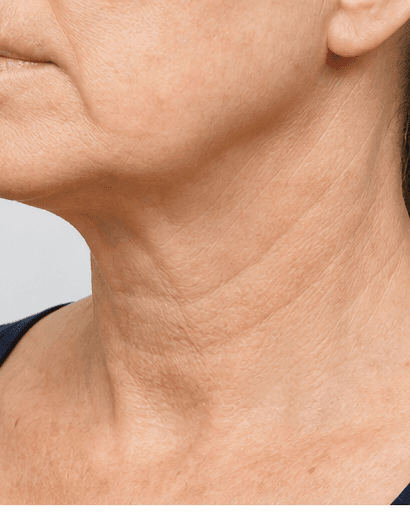 Neck Tightening RF: before