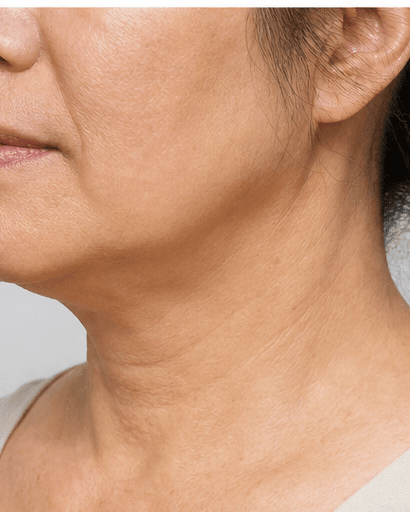 Neck Tightening RF: after
