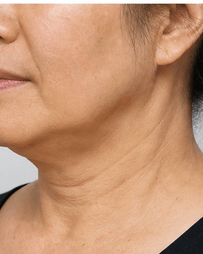 Neck Tightening RF: before