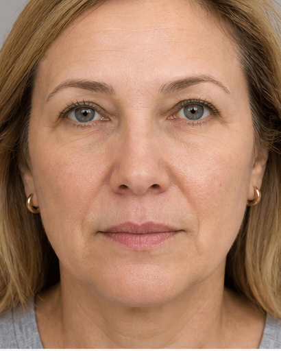 Ultherapy: after