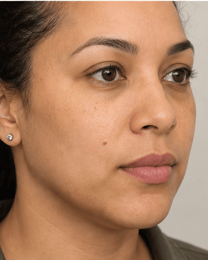Ultherapy: after