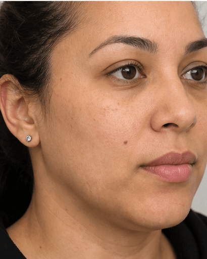 Ultherapy: before