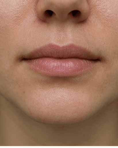 Chronic Chapped Lip Care: after