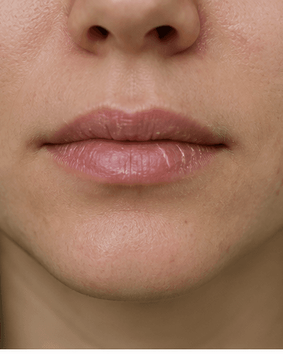 Chronic Chapped Lip Care: before