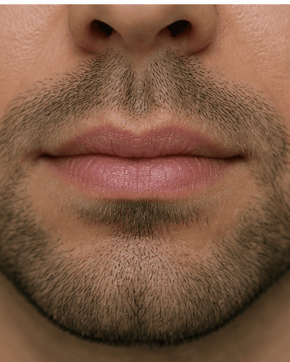 Chronic Chapped Lip Care: after