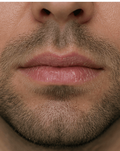 Chronic Chapped Lip Care: before