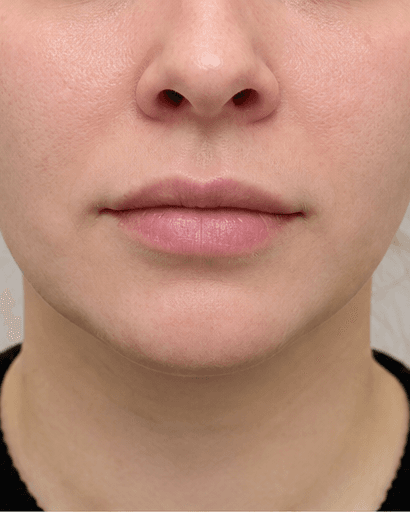 Lip Asymmetry Correction: after