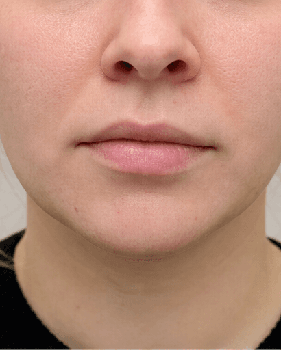 Lip Asymmetry Correction: before