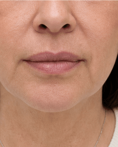 Lip Asymmetry Correction: after