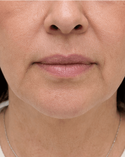 Lip Asymmetry Correction: before