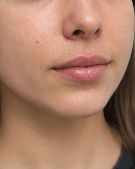 Lip Hydration Boost: after