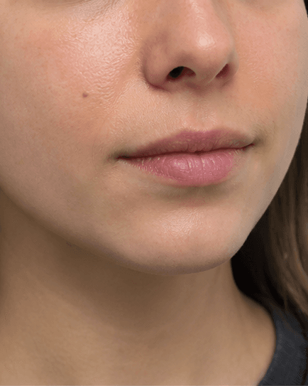Lip Hydration Boost: before
