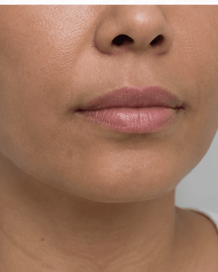 Lip Hydration Boost: after
