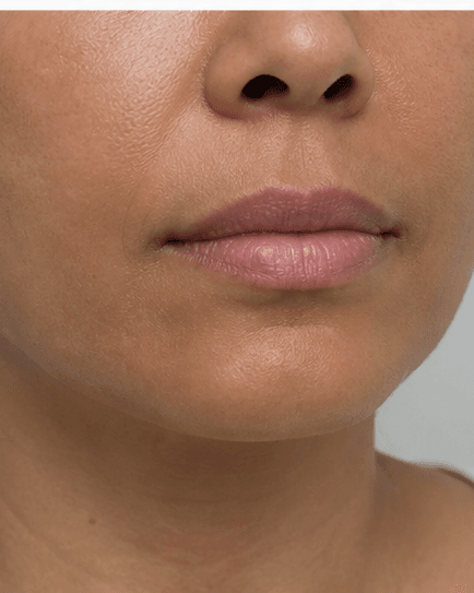 Lip Hydration Boost: before