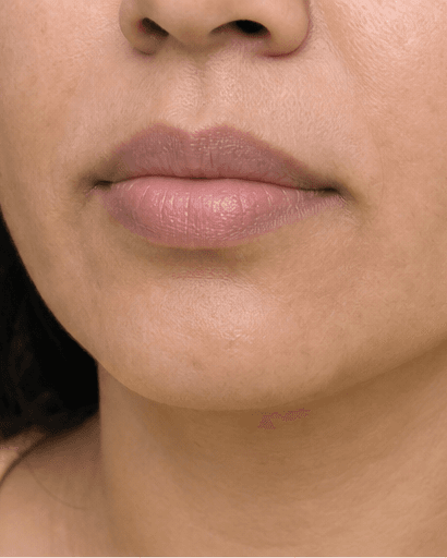 Lip Pigmentation Treatment: after