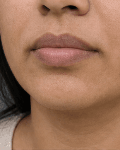 Lip Pigmentation Treatment: before
