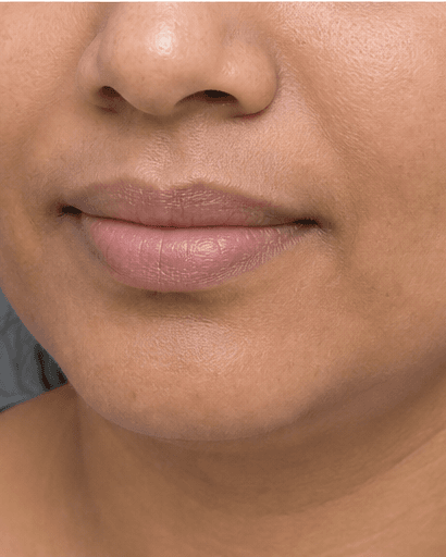Lip Pigmentation Treatment: after