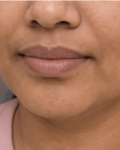 Lip Pigmentation Treatment: before