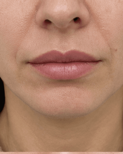 Russian Lip Technique: after