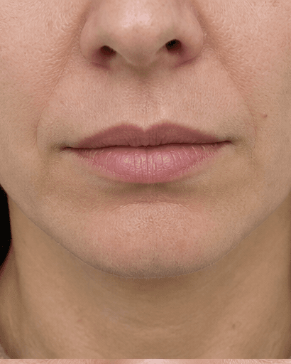 Russian Lip Technique: before