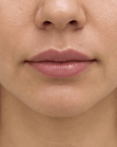 Russian Lip Technique: after