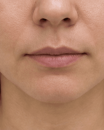 Russian Lip Technique: before