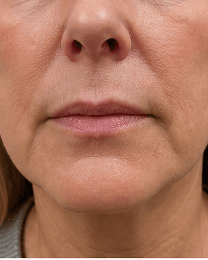 Perioral Line Treatment: after